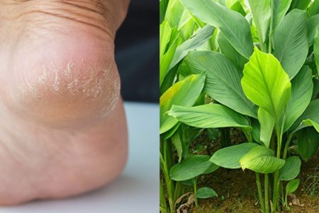 Home Remedies for Cracked Feet