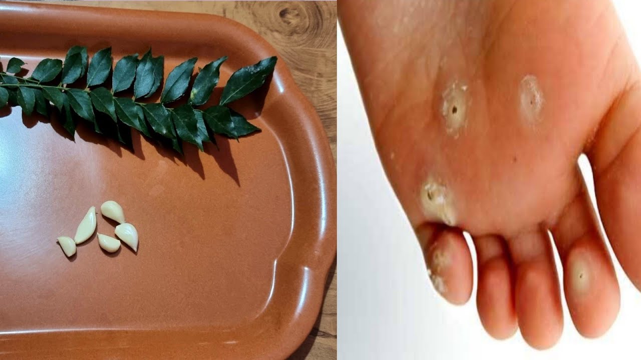 Home Remedies for Aani Rogam (Boils)