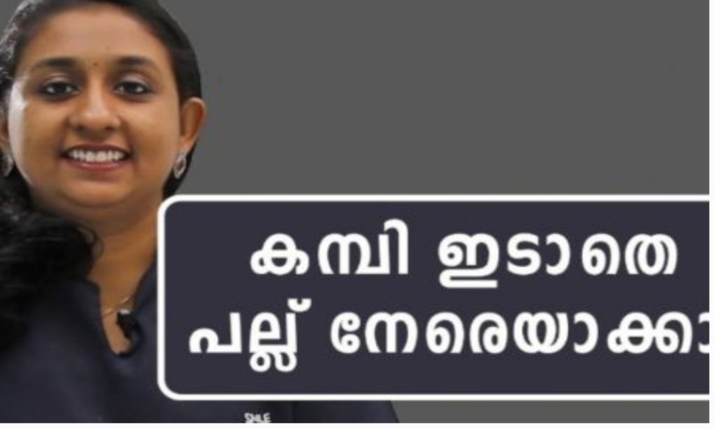 പല്ലിൽ കമ്പിയിടാതെ തന്നെ നമുക്ക് പല്ലുകൾ നേരെയാക്കാ൦! സൗന്ദര്യം വീണ്ടെടുക്കാം; വീഡിയോ ഒന്ന് കണ്ടു നോക്കൂ!! | Easy to Straighten Your Teeth Without Braces